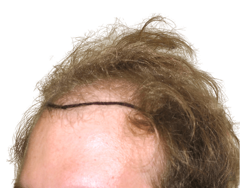 Hair transplant before & after. Receding hairline restored. Hair restoration results.