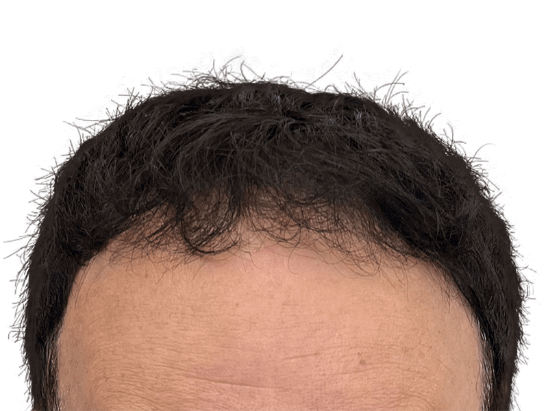 Receding hairline. Potential hair transplant candidate. Before hair restoration treatment. Thinning dark hair on fair skin.