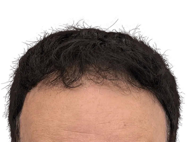 Receding hairline. Potential hair transplant candidate. Before hair restoration treatment. Thinning dark hair on fair skin.