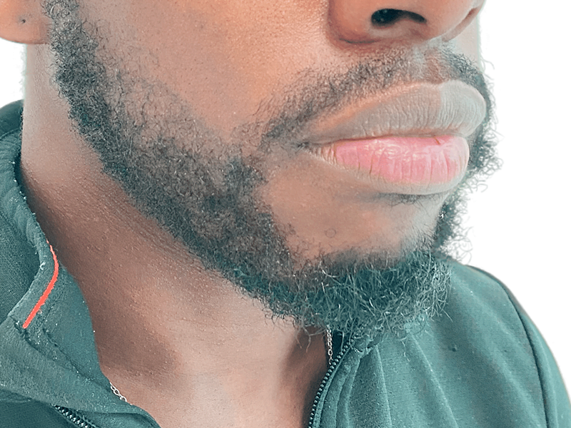 Beard detail, African American man. Could be used to showcase beard transplant results or hair restoration options.