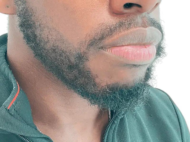 Beard detail, African American man. Could be used to showcase beard transplant results or hair restoration options.