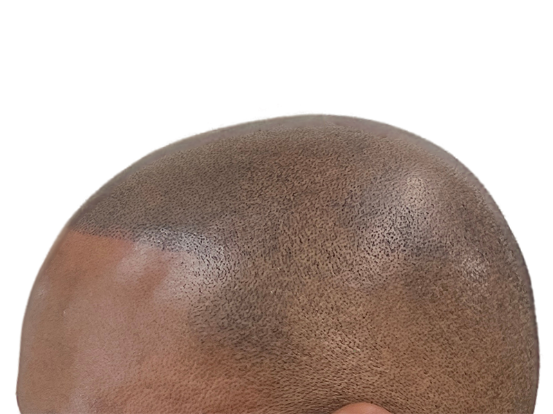 Hair transplant result: Dense, even hair growth on a shaved head. African American/Hispanic patient. Hair restoration success.