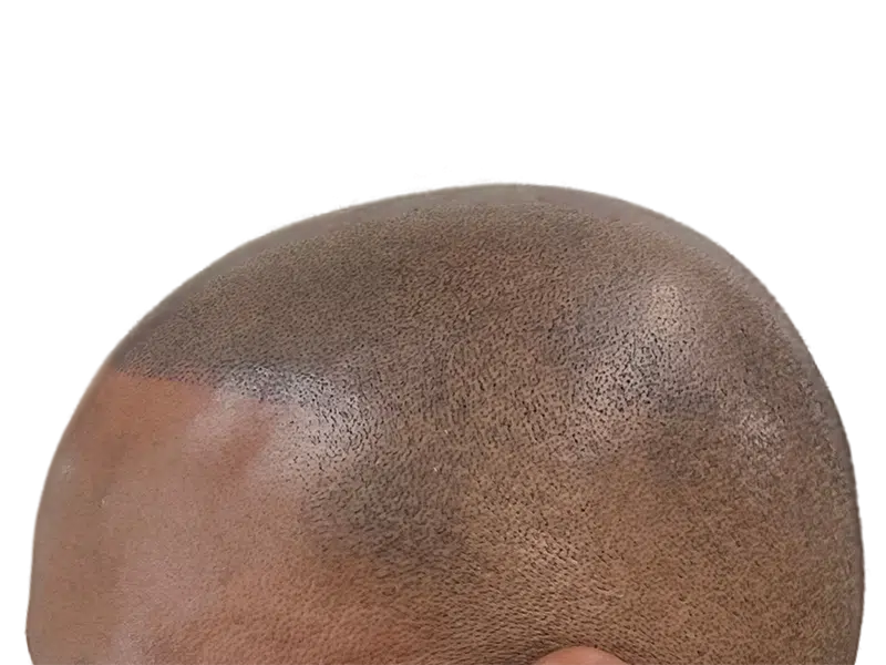Hair transplant result: Dense, even hair growth on a shaved head. African American/Hispanic patient. Hair restoration success.
