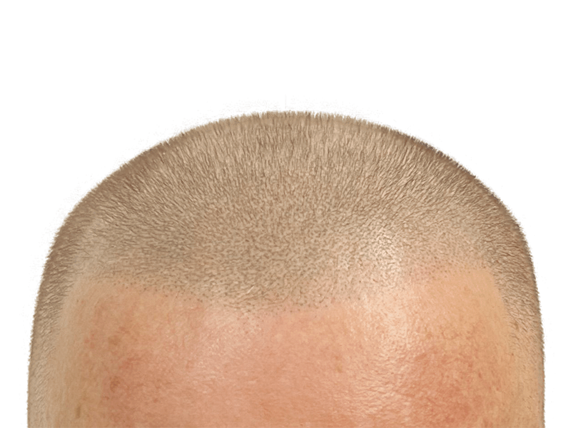 Hair transplant result: Close-up of restored hair growth. Even density, light brown hair. Hair restoration success.