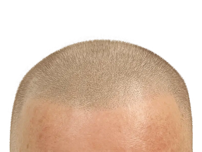 Hair transplant result: Close-up of restored hair growth. Even density, light brown hair. Hair restoration success.