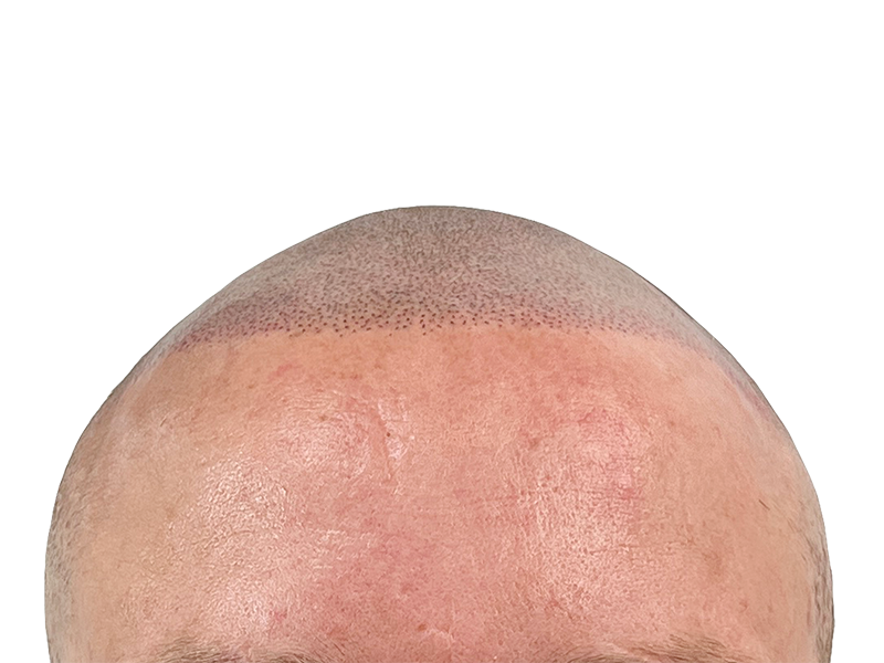 Hair restoration: Close-up of hairline after transplant. Shows new follicles/pigmentation & slight redness. Hair loss solution.