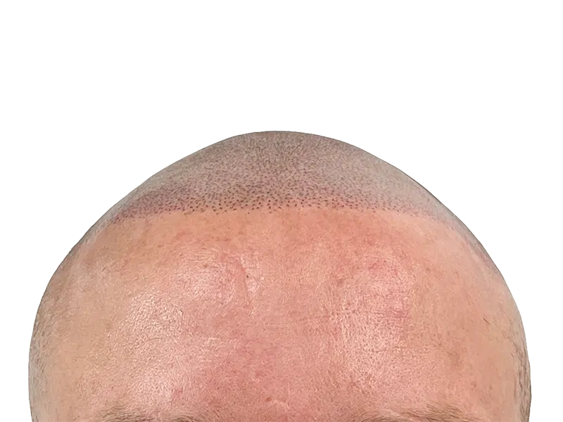Hair restoration: Close-up of hairline after transplant. Shows new follicles/pigmentation & slight redness. Hair loss solution.