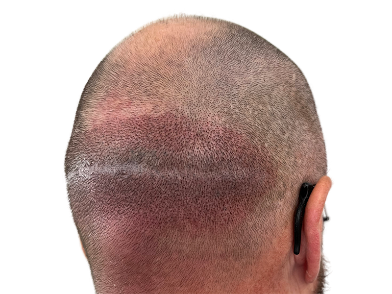 Hair transplant scar on shaved head. Result of hair restoration procedure. Before/after evidence of successful transplant.