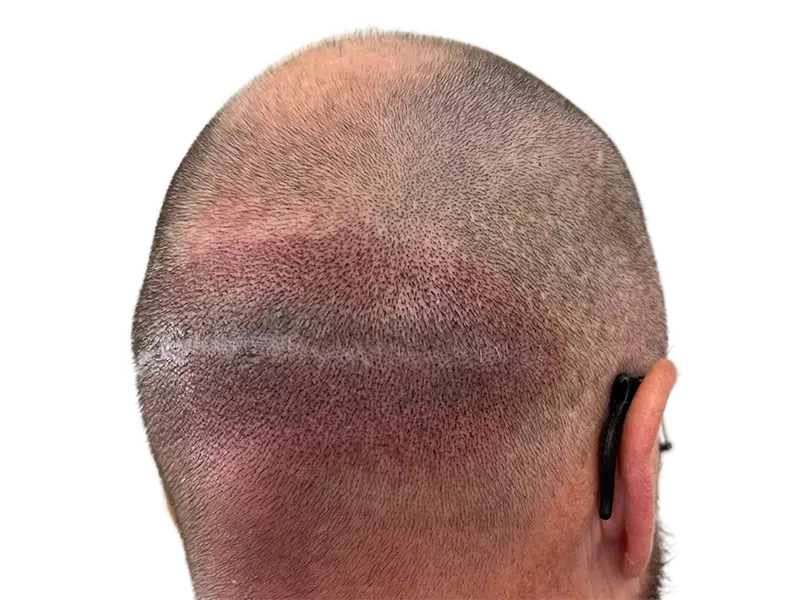 Hair transplant scar on shaved head. Result of hair restoration procedure. Before/after evidence of successful transplant.