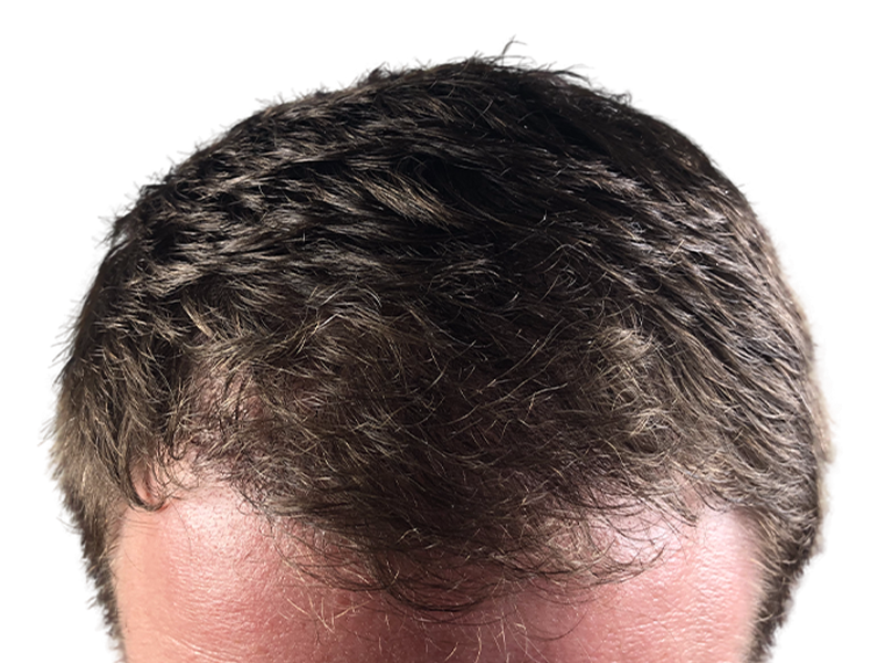 Thinning dark brown hair at hairline. Potential hair restoration candidate. Before hair transplant assessment.
