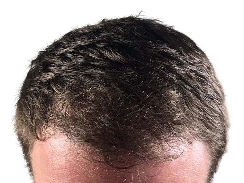 Thinning dark brown hair at hairline. Potential hair restoration candidate. Before hair transplant assessment.
