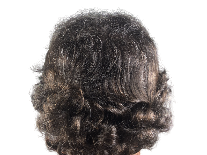 Dense, graying hair. Potential hair restoration result? Natural coverage. Hair transplant evaluation possible.
