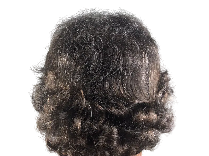 Dense, graying hair. Potential hair restoration result? Natural coverage. Hair transplant evaluation possible.