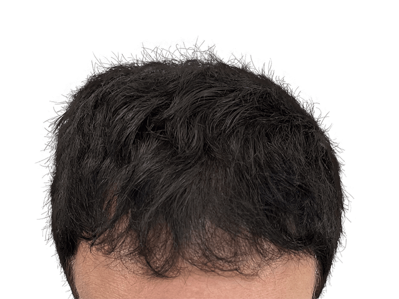 Dense, healthy hair after restoration. Hair transplant result showing thick, even coverage. Before/after potential.