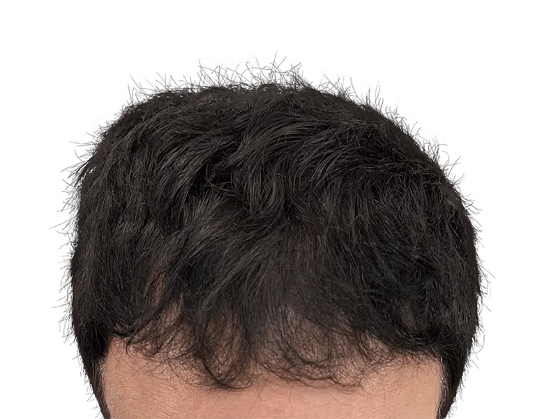 Dense, healthy hair after restoration. Hair transplant result showing thick, even coverage. Before/after potential.