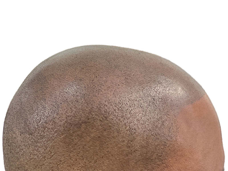 Hair transplant result: Close-up of restored hairline on dark skin. Before & after hair restoration success.