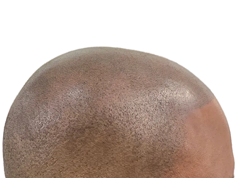 Hair transplant result: Close-up of restored hairline on dark skin. Before & after hair restoration success.