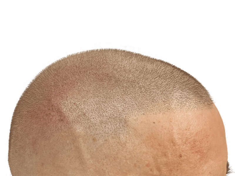 Hair transplant result: Uniform, dense hair growth on scalp. Natural hairline achieved. Hair restoration success.