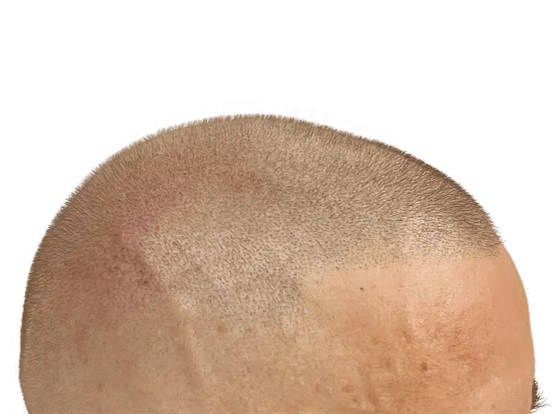 Hair transplant result: Uniform, dense hair growth on scalp. Natural hairline achieved. Hair restoration success.