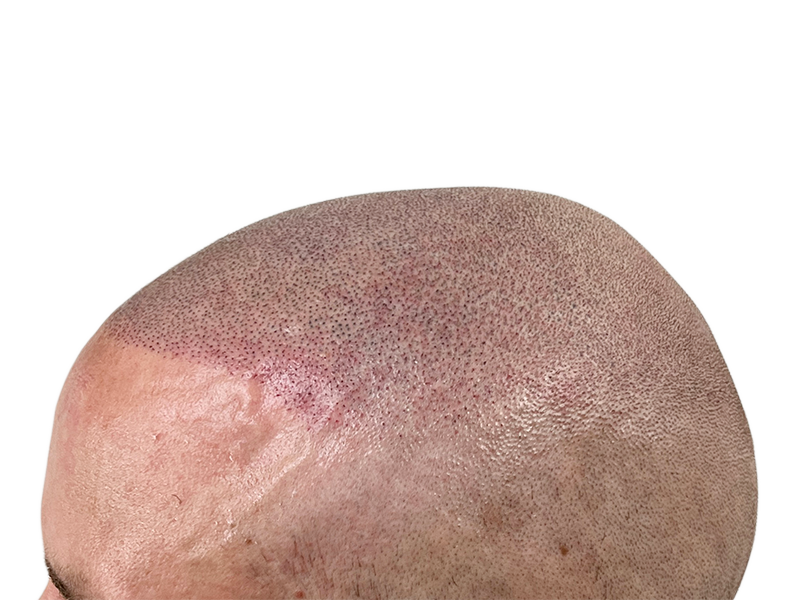 Hair transplant close-up: Newly transplanted follicles visible. Redness and swelling post-procedure. Hair restoration results.