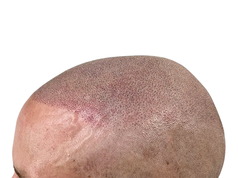 Hair transplant close-up: Newly transplanted follicles visible. Redness and swelling post-procedure. Hair restoration results.