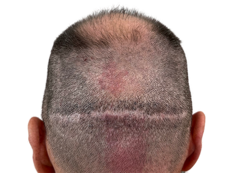Hair transplant result: Scar from FUT procedure with denser hair growth above. Before & after hair restoration example.