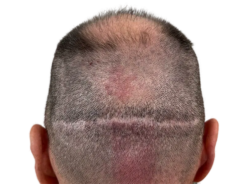 Hair transplant result: Scar from FUT procedure with denser hair growth above. Before & after hair restoration example.