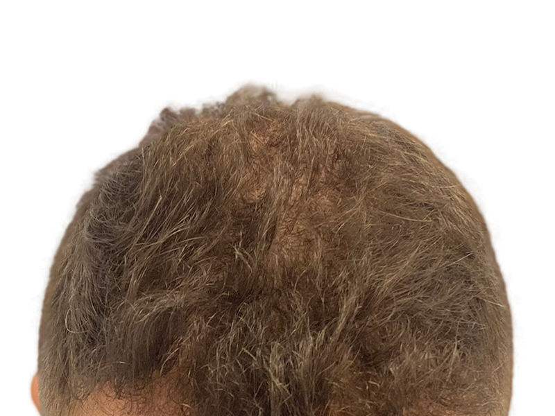Thinning light brown hair, visible scalp. Potential hair loss candidate. Consider hair restoration options.