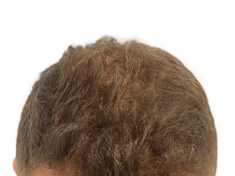 Thinning light brown hair, visible scalp. Potential hair loss candidate. Consider hair restoration options.