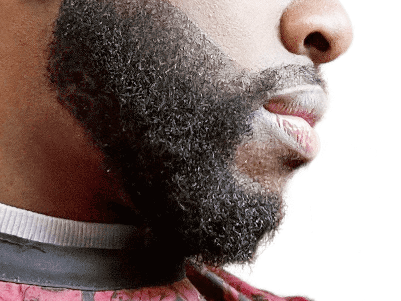 Full, healthy beard on African American man. Hair restoration results. Before hair transplant not visible.