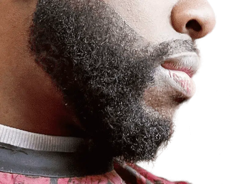Full, healthy beard on African American man. Hair restoration results. Before hair transplant not visible.