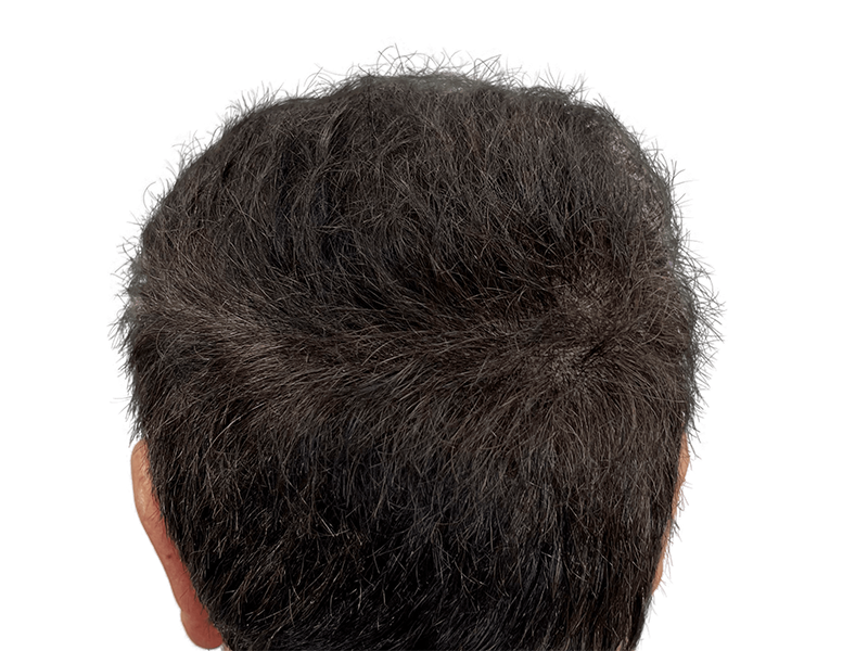 Thinning hair on back of head. Potential hair restoration candidate. Before hair transplant. Sparse dark hair.