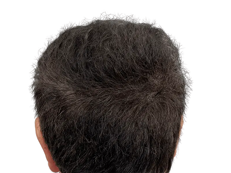 Thinning hair on back of head. Potential hair restoration candidate. Before hair transplant. Sparse dark hair.