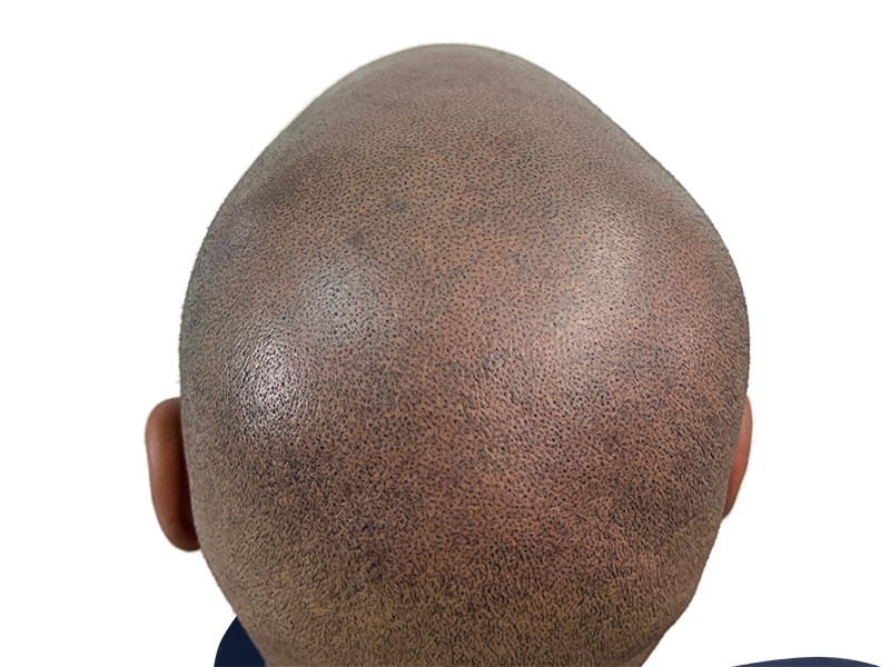 Hair transplant result: Dense follicle placement on shaved scalp. Restored hairline. Before & after hair restoration.