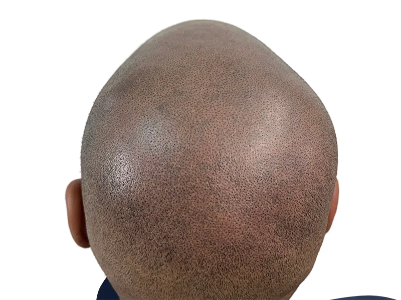 Hair transplant result: Dense follicle placement on shaved scalp. Restored hairline. Before & after hair restoration.