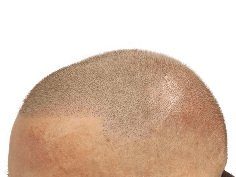 Hair transplant result: Close-up of restored hairline. Before & after shows improved density. Hair restoration success.