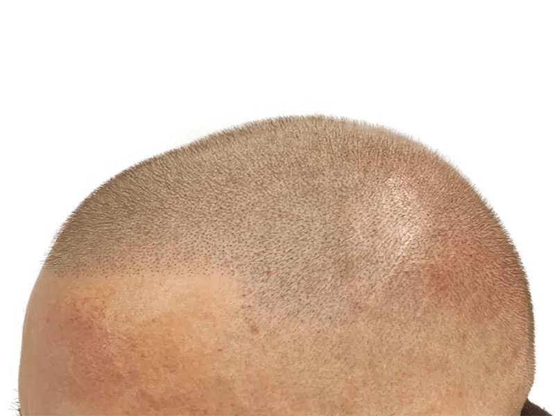 Hair transplant result: Close-up of restored hairline. Before & after shows improved density. Hair restoration success.