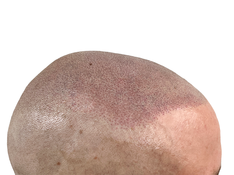 Hair transplant result: Caucasian man's head showing restored hair density. Before/after hair restoration success.