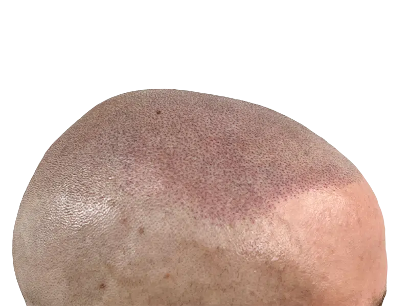 Hair transplant result: Caucasian man's head showing restored hair density. Before/after hair restoration success.