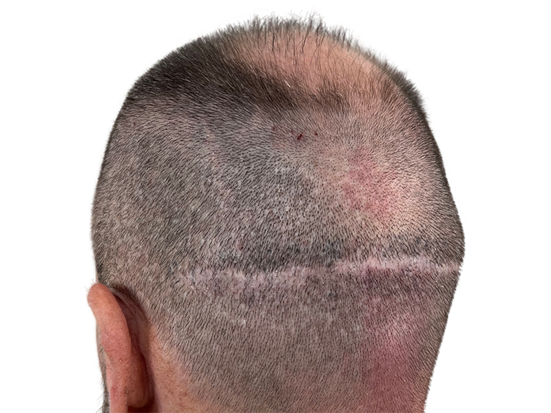 Hair transplant scar on scalp. Thinning hair above, denser hair below. Hair restoration procedure result.