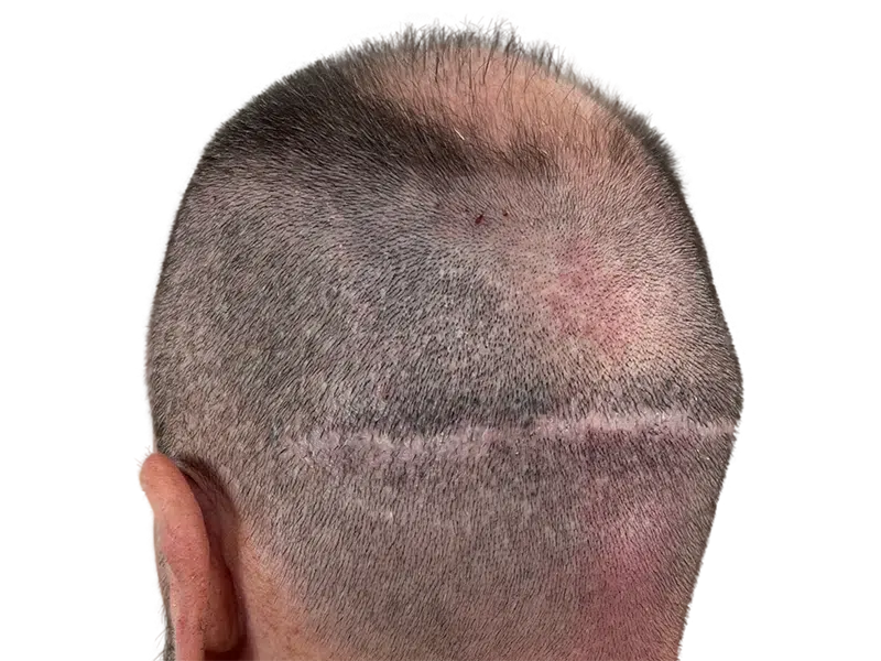 Hair transplant scar on scalp. Thinning hair above, denser hair below. Hair restoration procedure result.