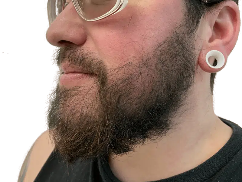 Full, dark beard on a man with thick hair. Example of natural hair growth, not a hair transplant result. White ear gauge visible.