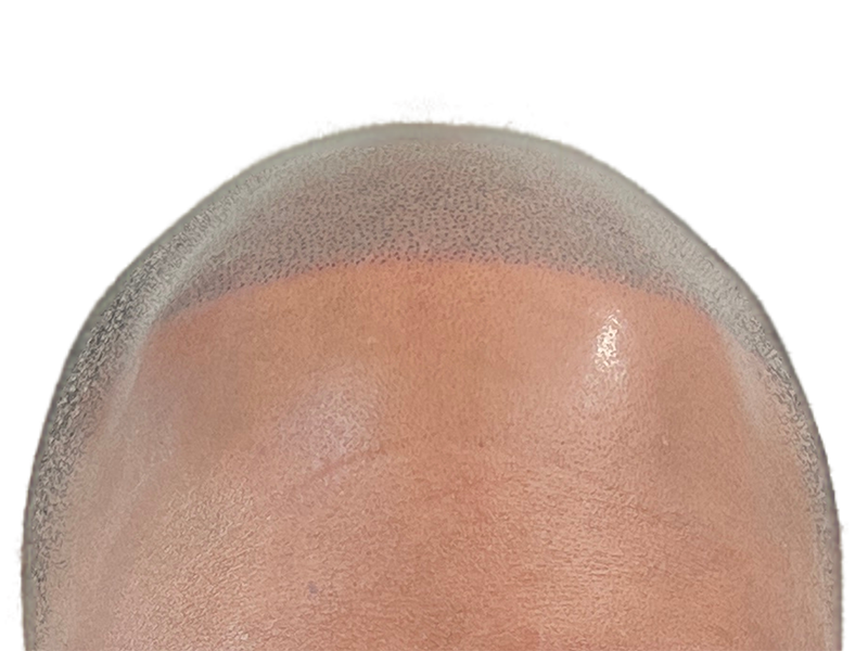 Hair transplant result: Restored hairline with dense, transplanted follicles. Natural-looking hair restoration after procedure.