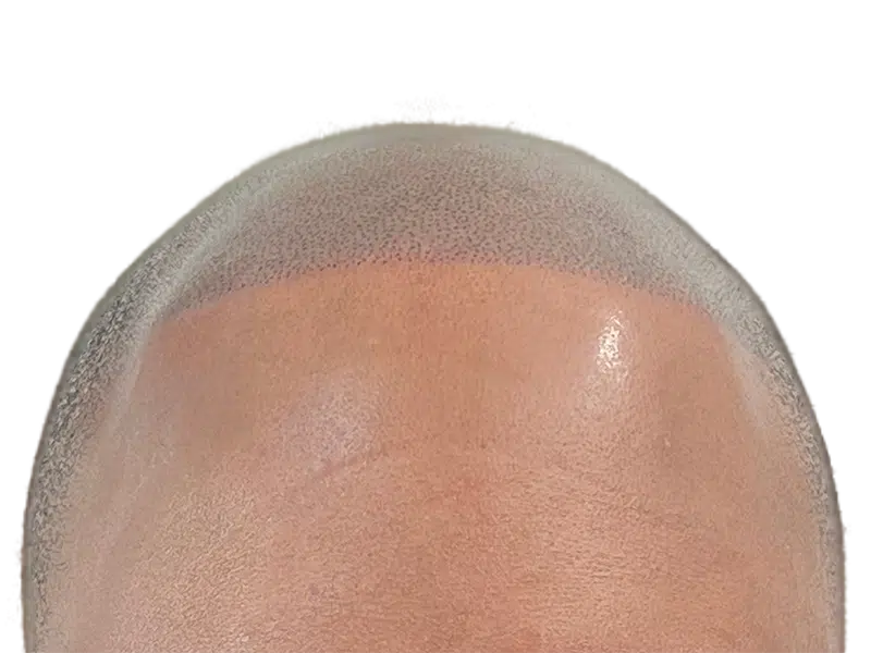Hair transplant result: Restored hairline with dense, transplanted follicles. Natural-looking hair restoration after procedure.