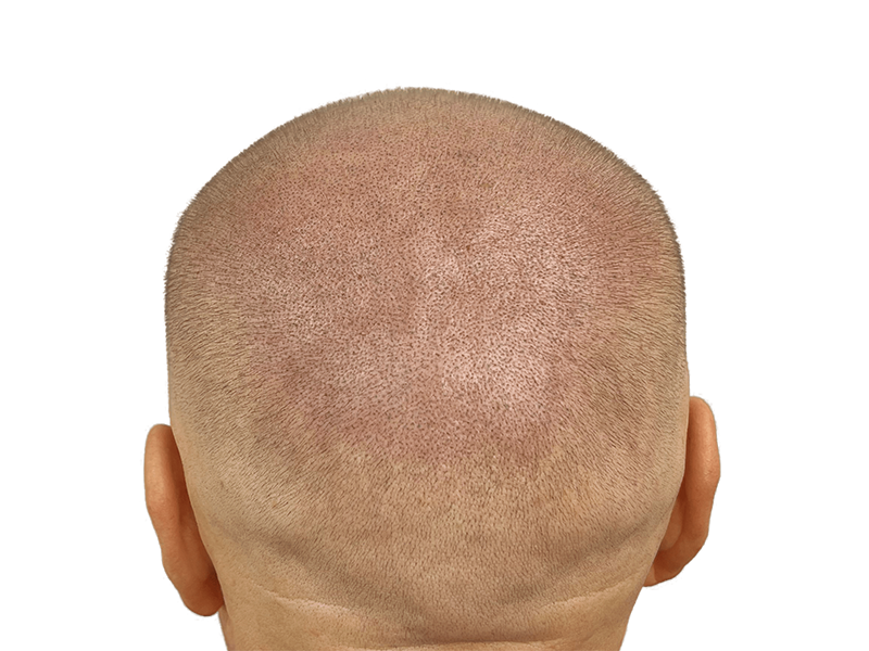 Shaved head showing even hair distribution. Possible hair transplant result. Hair restoration procedure outcome.