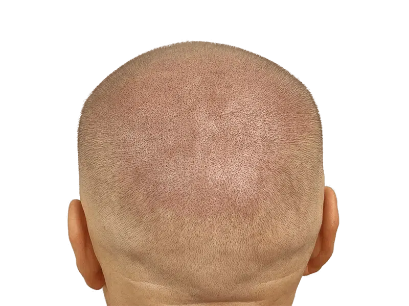 Shaved head showing even hair distribution. Possible hair transplant result. Hair restoration procedure outcome.