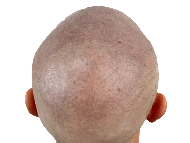 Bald head, likely candidate for hair restoration. Possible hair transplant before image. Evaluate hair loss solutions.