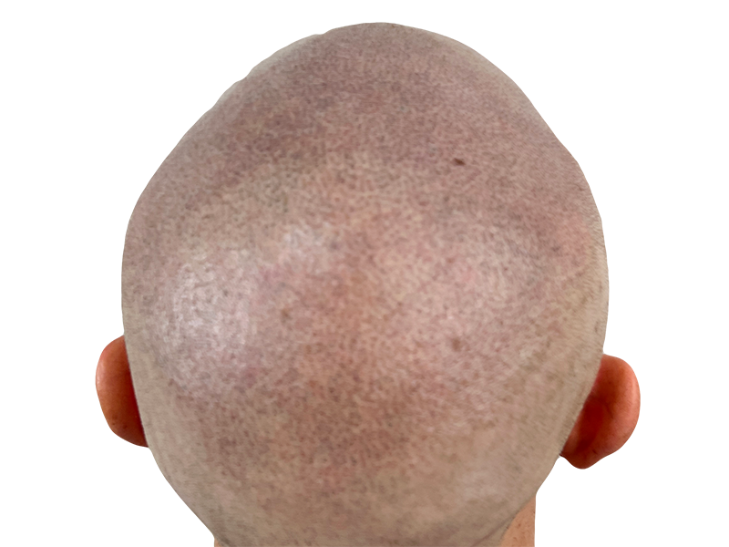 Balding head before hair restoration. Shows thinning hair and scalp. Potential hair transplant candidate.