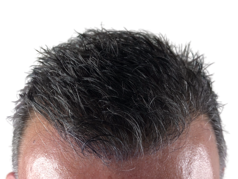 Hair restoration result. Close-up of healthy, styled hair after transplant. Improved density, natural look.