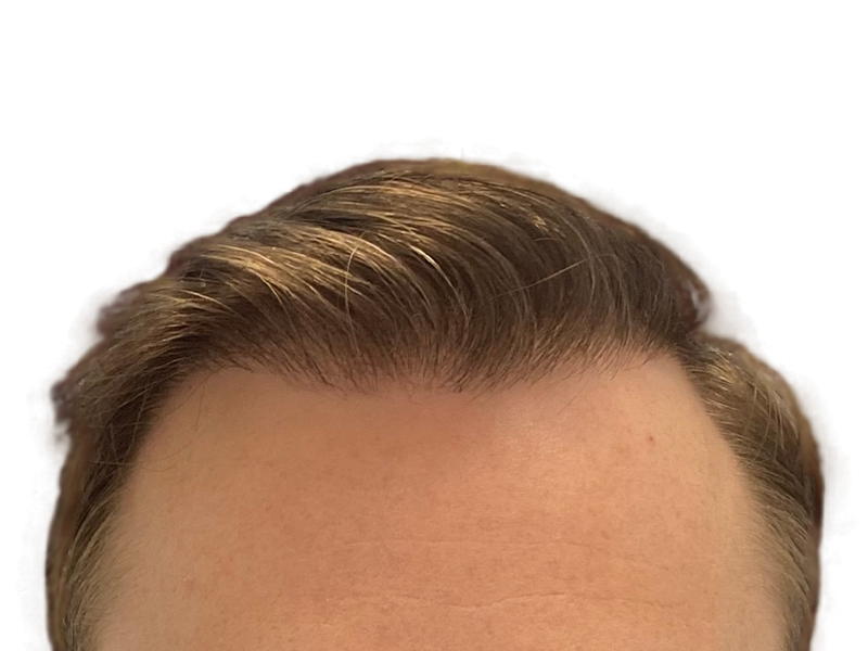 Dense, light brown hairline. Possible hair transplant result. Forehead view. Hair restoration success.